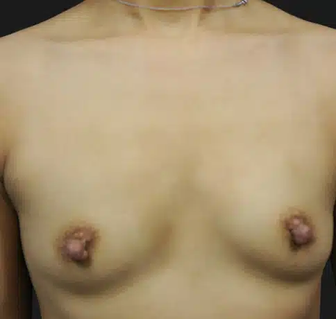 Case 23088, Performed By Dr. Tehrani – Before