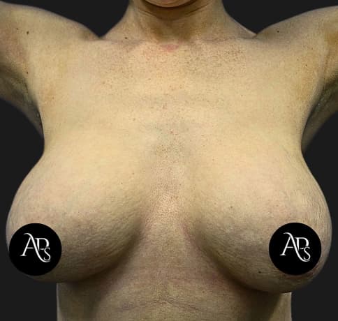 Case 54931, Performed By Dr. Tehrani – Before