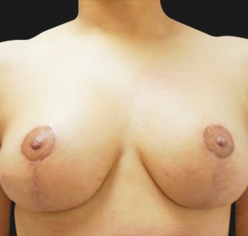 Case 118, Performed By Dr. Tehrani – After