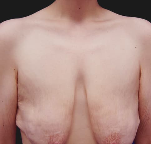 Case 24028, Performed By Dr. Tehrani – Before