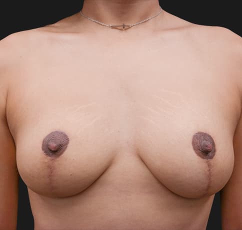 Case 55891, Performed By Dr. Tehrani – After