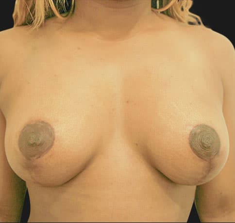 Case 16041, Performed By Dr. Tehrani – After