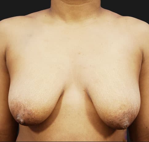 Case 16041, Performed By Dr. Tehrani – Before
