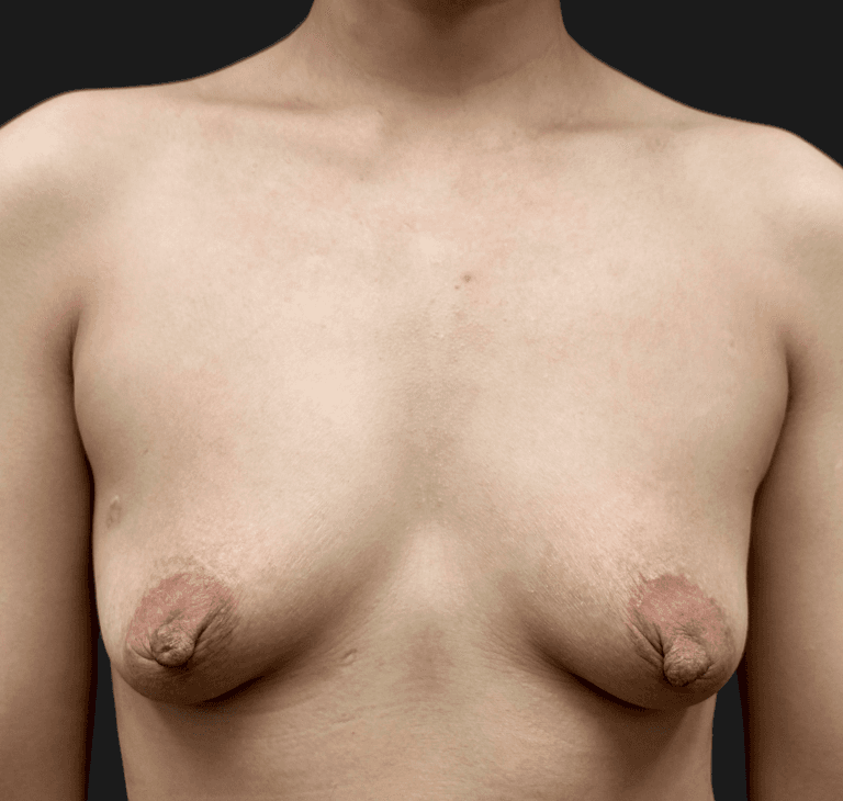 Case 63275, Performed By Dr. Tehrani – Before