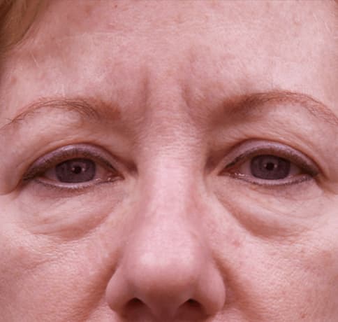 Case 32108 , Performed By Dr. Tehrani – Before