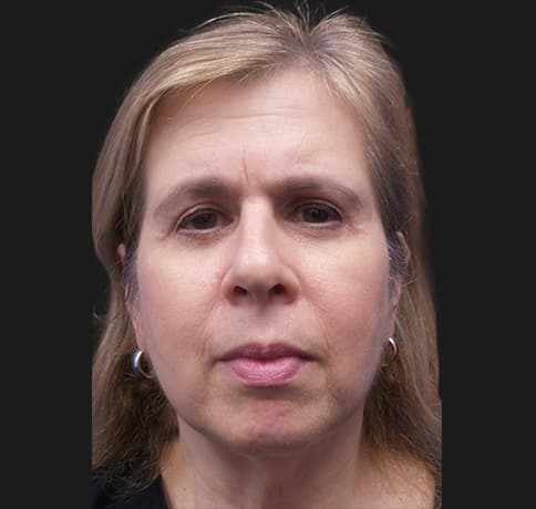 Case 33290, Performed By Dr. Tehrani – After