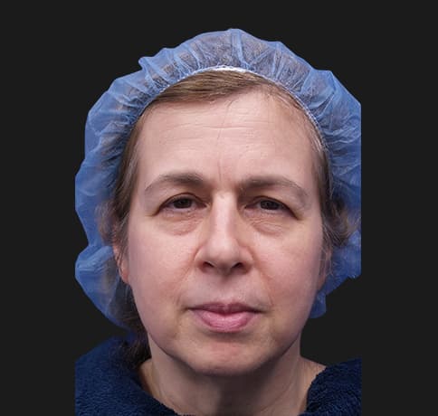 Case 33290, Performed By Dr. Tehrani – Before