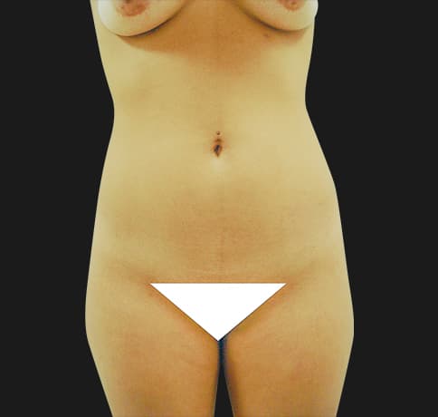 Case 7582, Performed By Dr. Tehrani – Before
