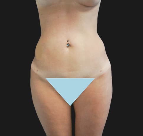 Case 22943, Performed By Dr. Tehrani – Before