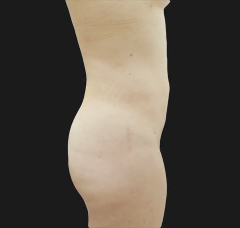 Case 30513, Performed By Dr. Tehrani – After