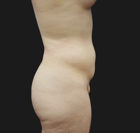 Case 30513, Performed By Dr. Tehrani – Before