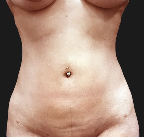 Case 41115, Performed By Dr. Tehrani – After