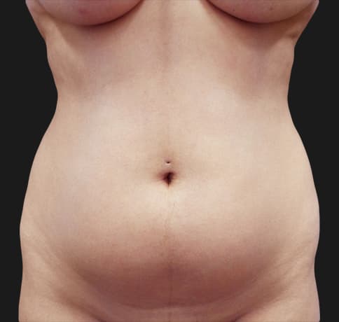 Case 41115, Performed By Dr. Tehrani – Before