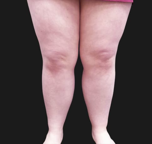Case 42619, Performed By Dr. Tehrani – Before