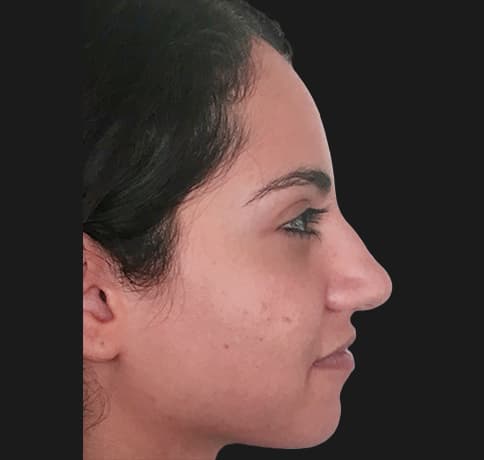 Case 34106 , Performed By Dr. Tehrani – Before