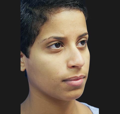 Case 21237 , Performed By Dr. Tehrani – Before
