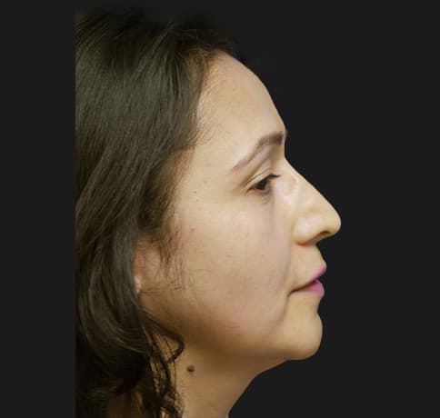 Case 12767 , Performed By Dr. Tehrani – After