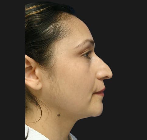 Case 12767 , Performed By Dr. Tehrani – Before
