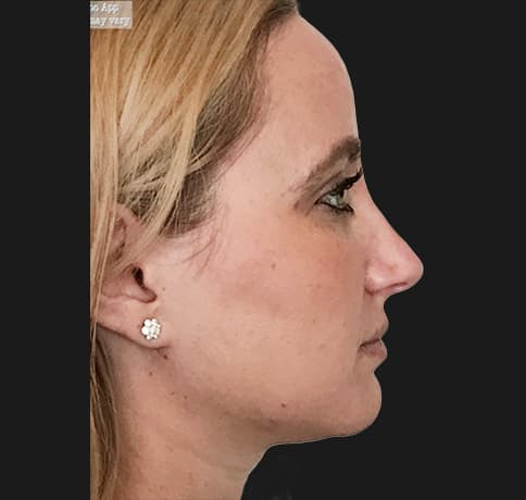 Case 36917 , Performed By Dr. Tehrani – After