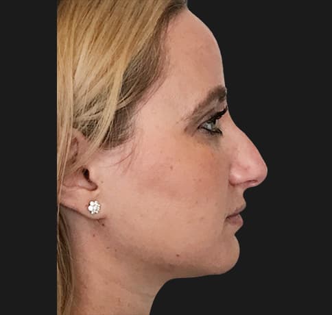 Case 36917 , Performed By Dr. Tehrani – Before