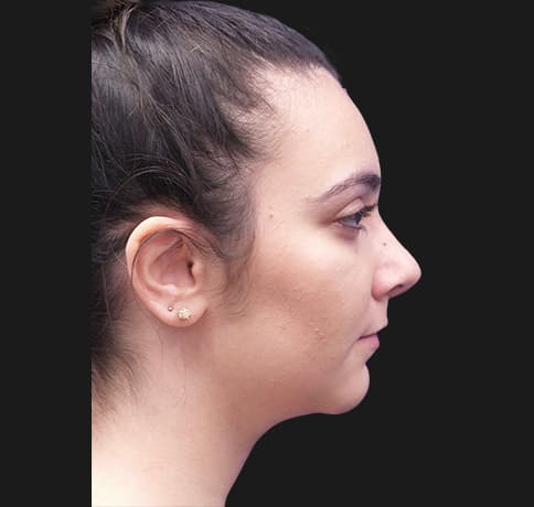 Case 38937 , Performed By Dr. Tehrani – After