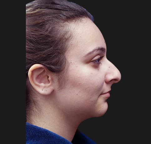 Case 38937 , Performed By Dr. Tehrani – Before