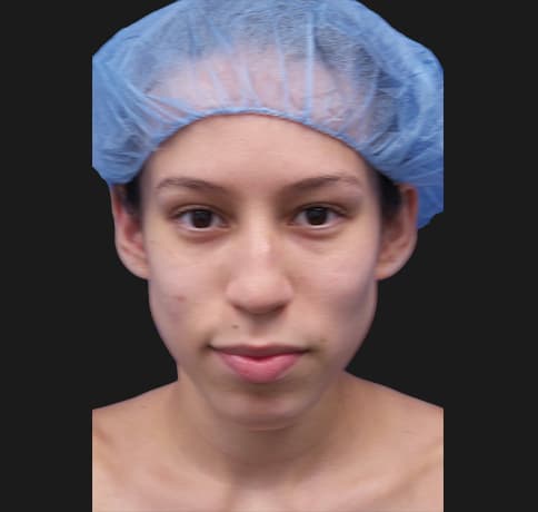 Case 38420 , Performed By Dr. Tehrani – Before