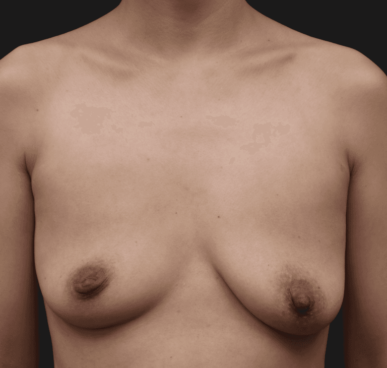 Case 43478, Performed By Dr. Tehrani – Before