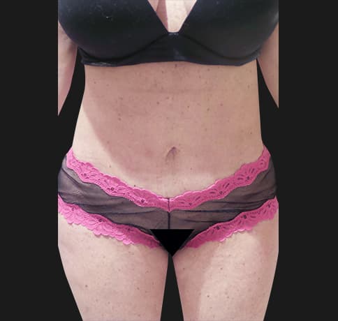 Case 35732, Performed By Dr. Tehrani – After