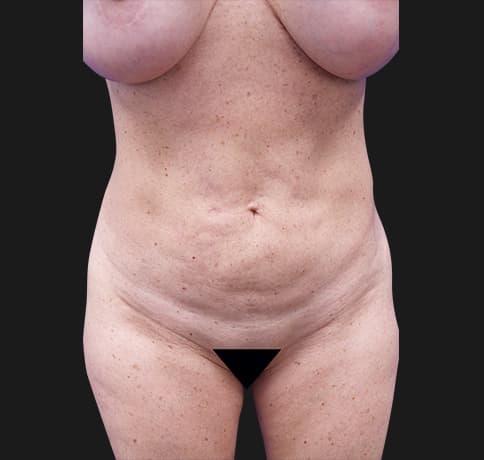 Case 35732, Performed By Dr. Tehrani – Before