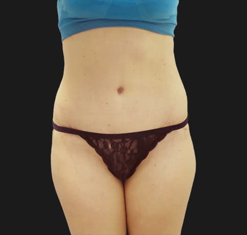Case 37833, Performed By Dr. Tehrani – After