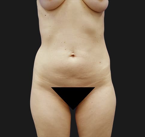 Case 37833, Performed By Dr. Tehrani – Before