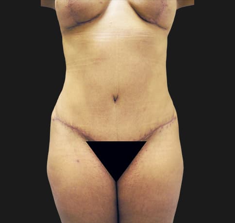 Case 19273 , Performed By Dr. Tehrani – After