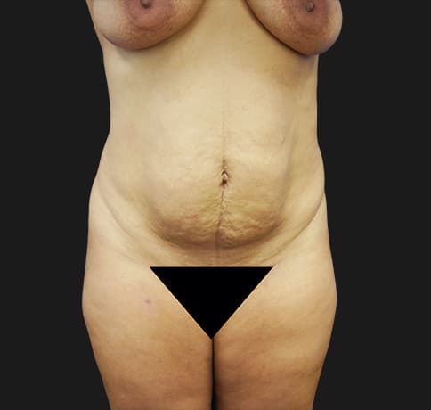 Case 19273 , Performed By Dr. Tehrani – Before