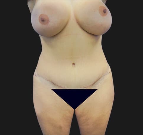 Case 22932, Performed By Dr. Tehrani – After