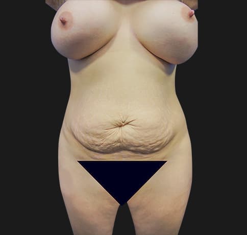 Case 22932, Performed By Dr. Tehrani – Before