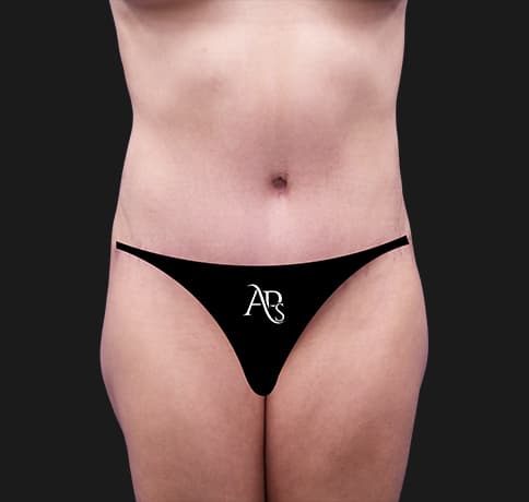 Case 36646, Performed By Dr. Tehrani – After