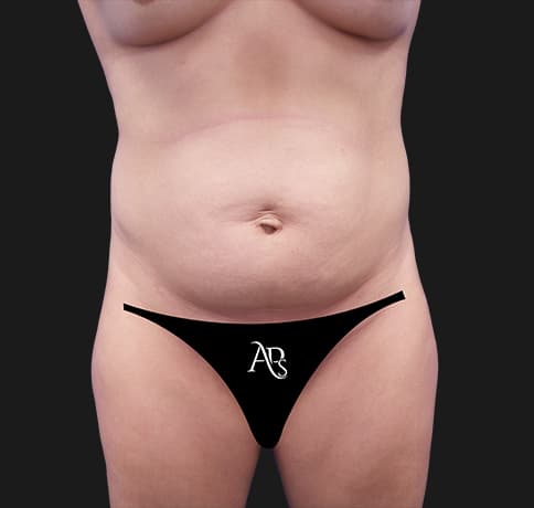 Case 36646, Performed By Dr. Tehrani – Before