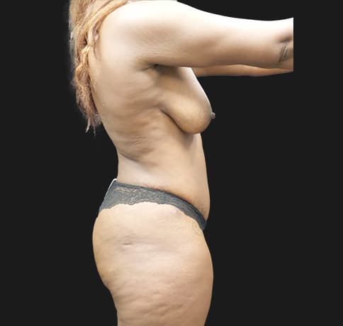 Case 49525, Performed By Dr. Tehrani – After