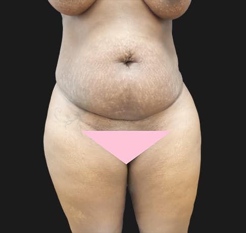 Case 49525, Performed By Dr. Tehrani – Before