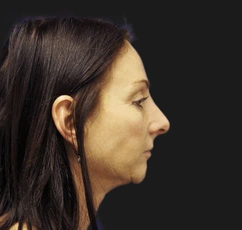 Case 13575, Performed By Dr. Tehrani – After