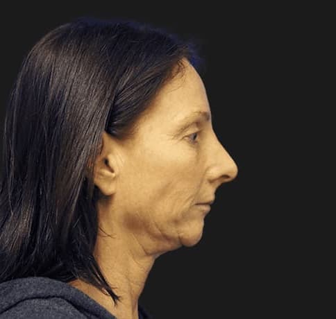 Case 13575, Performed By Dr. Tehrani – Before