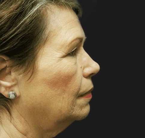 Case 14402, Performed By Dr. Tehrani – Before
