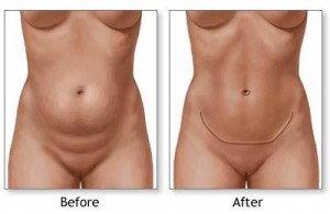 Tummy Tuck Before and After