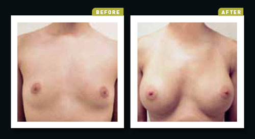 Breast Augmentation