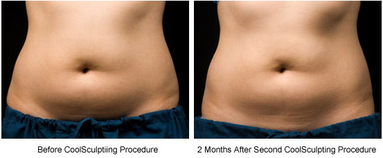 CoolSculpting NYC