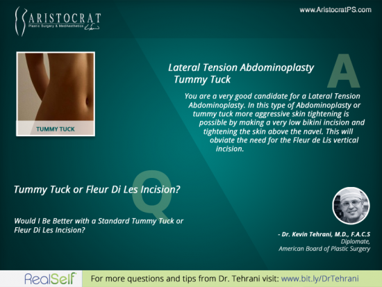 Aristocrat-tummy-tuck