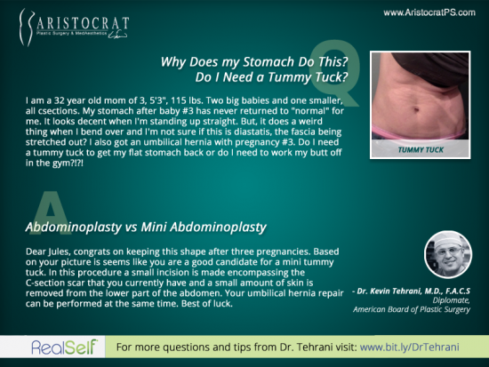 abdominoplasty-plastic-surgery