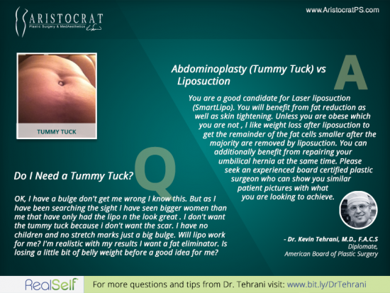 Do-i-need-a-tummy-tuck