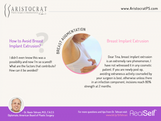 Avoid-Breast-Implant-Extrusion